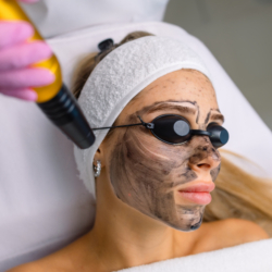 Lazerinis veido odos atjauninimas - šveitimas su anglimi (Carbon Laser Peel)
