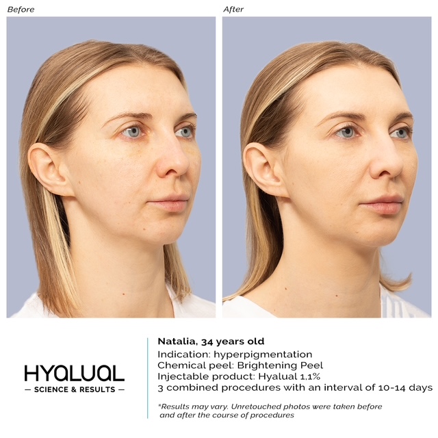 Redermalizacija su gintaro ir hialurono rūgštimi - Image 2
