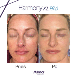 pigmentacijos gydymas